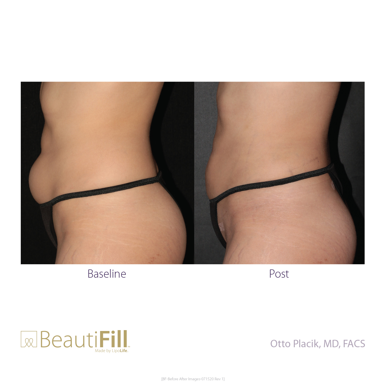 BeautiFill-Before and After B2B 082820-10
